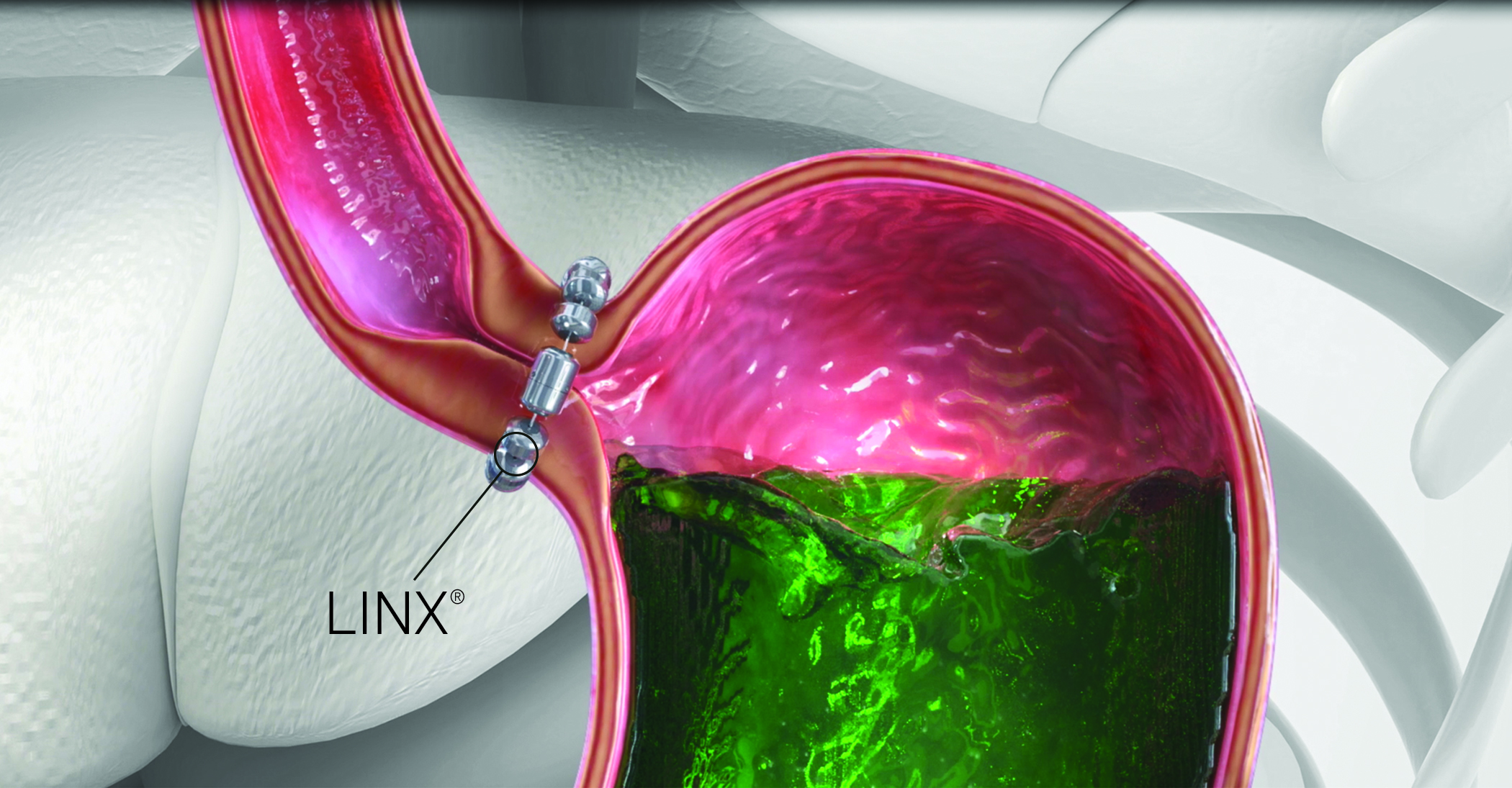 Living with GERD? Learn About LINX Procedure & Don’t Suffer Any Longer ...