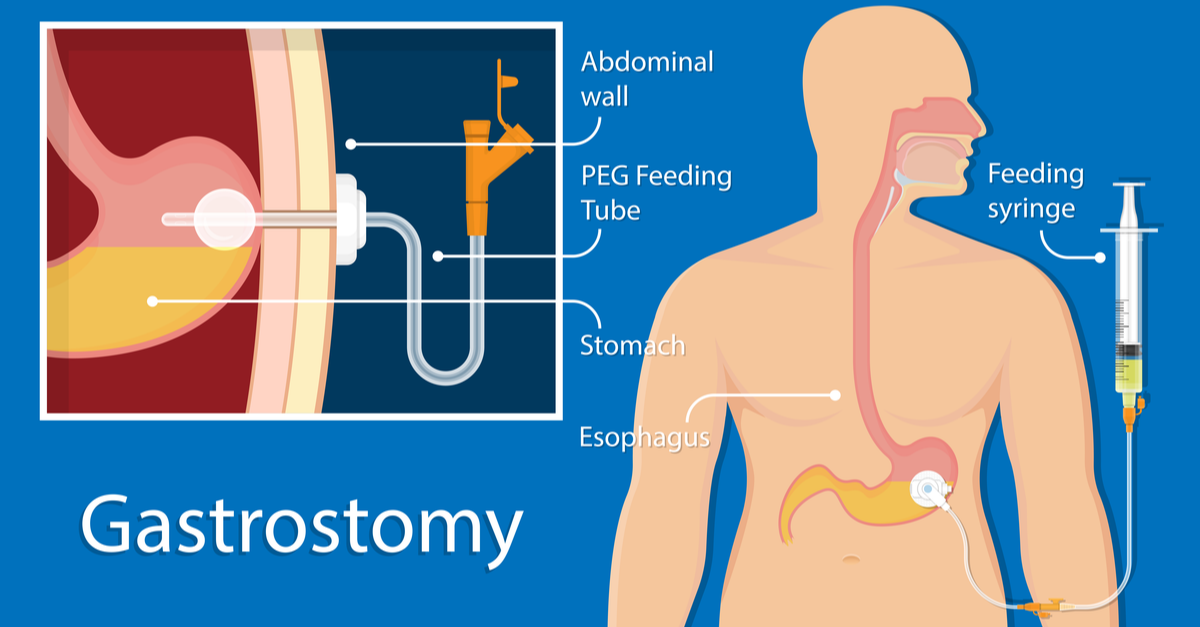 Everything You Need To Know About A PEG Tube Maryland Bariatrics