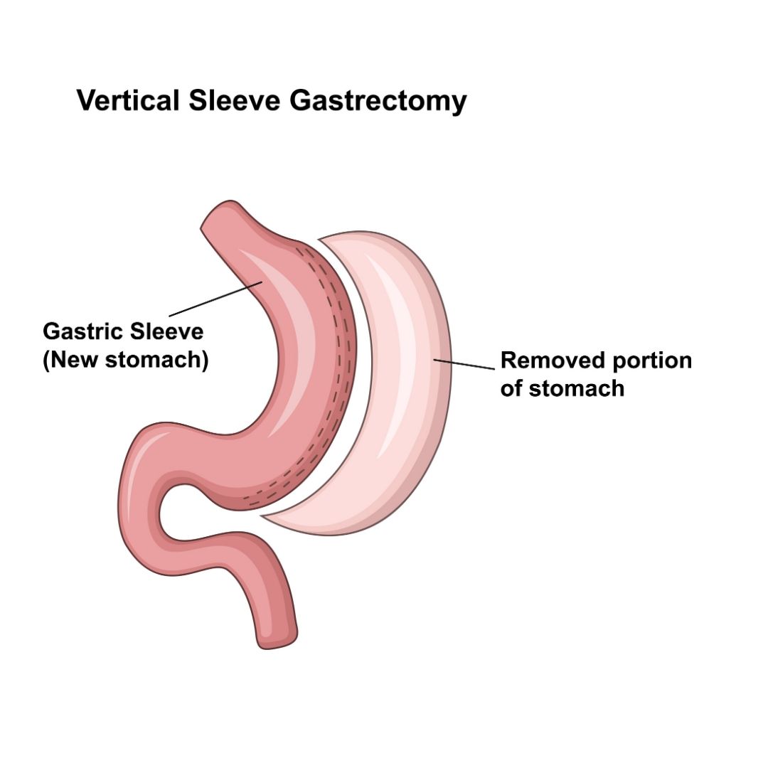 sleeve gastrectomy surgery