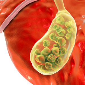 gallbladder stone surgery maryland